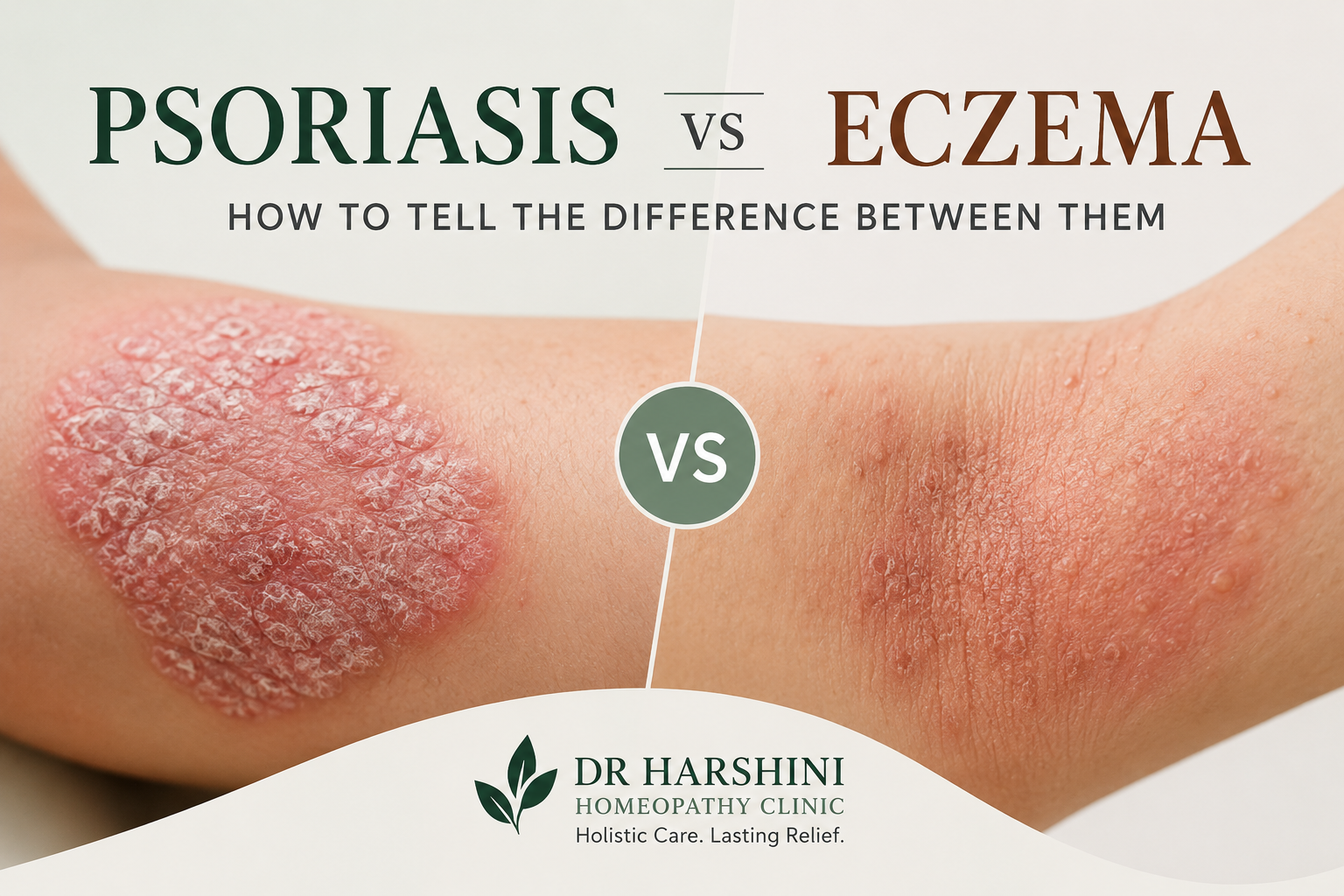 Psoriasis vs Eczema: Symptoms, Causes & Key Differences