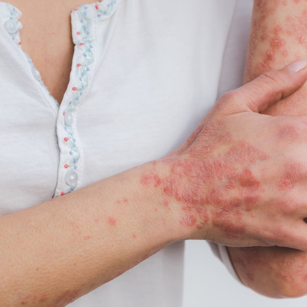 Psoriasis? Symptoms- medicine- Treatment | Singapore