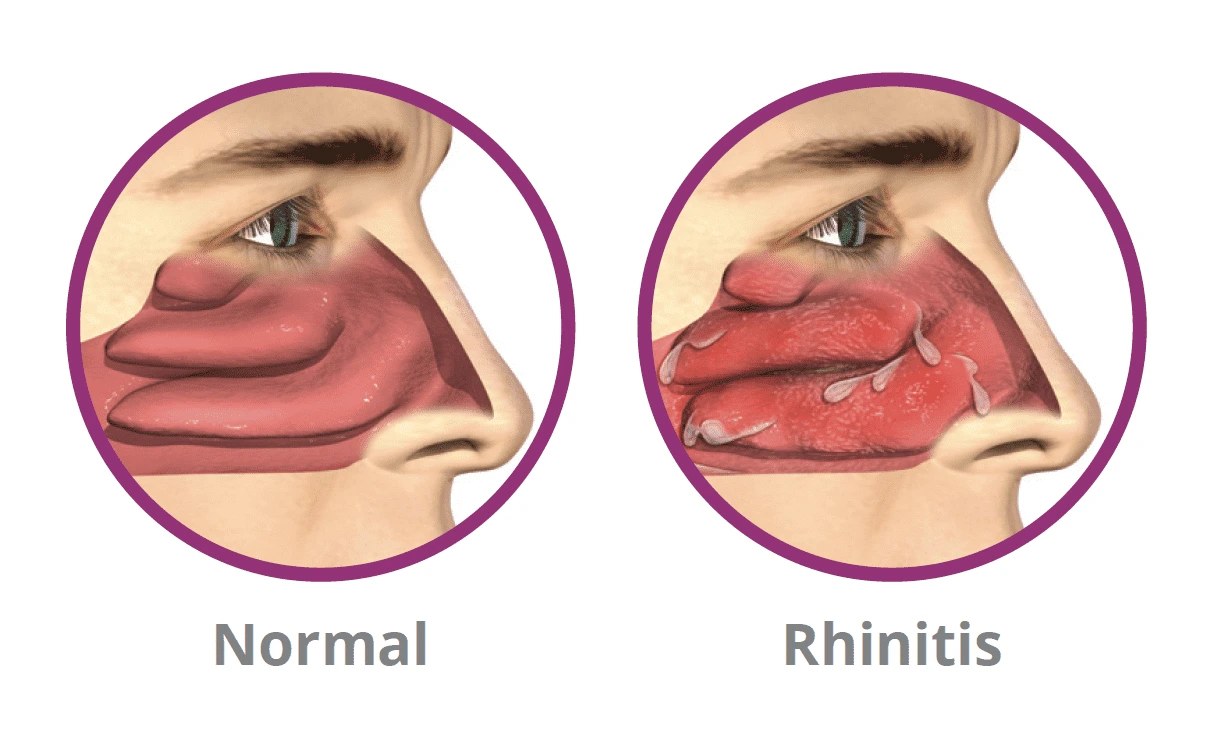 Allergic Rhinitis Treatment in Singapore.